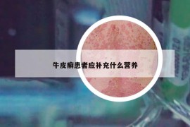 牛皮癣患者应补充什么营养