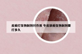 皮癣打生物制剂付作用 牛皮肤癣生物制剂要打多久