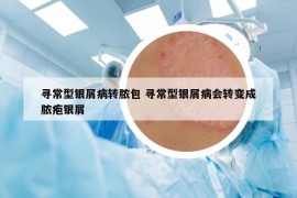 寻常型银屑病转脓包 寻常型银屑病会转变成脓疱银屑