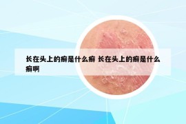 长在头上的癣是什么癣 长在头上的癣是什么癣啊