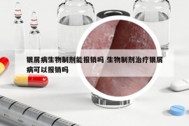 银屑病生物制剂能报销吗 生物制剂治疗银屑病可以报销吗