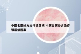 中医名医妙方治疗银屑病 中医名医妙方治疗银屑病医案