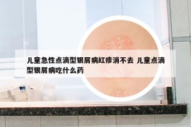 儿童急性点滴型银屑病红疹消不去 儿童点滴型银屑病吃什么药