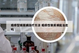 疱疹型银屑病治疗方法 疱疹性银屑病能治愈吗