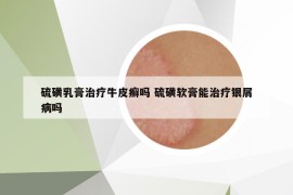 硫磺乳膏治疗牛皮癣吗 硫磺软膏能治疗银屑病吗