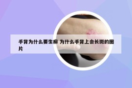 手背为什么要生癣 为什么手背上会长斑的图片