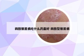 四肢银屑病吃什么药最好 四肢型银屑病