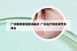 广州哪里看银屑病最好 广州治疗银屑病专家排名