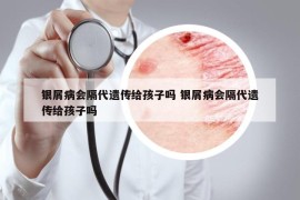 银屑病会隔代遗传给孩子吗 银屑病会隔代遗传给孩子吗