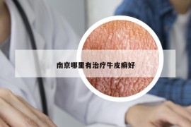 南京哪里有治疗牛皮癣好