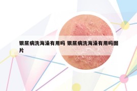 银屑病洗海澡有用吗 银屑病洗海澡有用吗图片