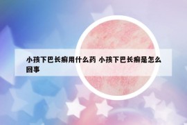 小孩下巴长癣用什么药 小孩下巴长癣是怎么回事