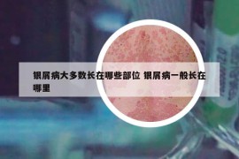 银屑病大多数长在哪些部位 银屑病一般长在哪里