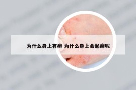 为什么身上有癣 为什么身上会起癣呢