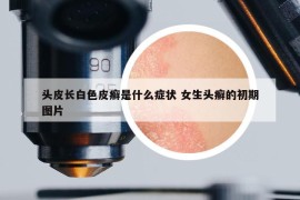 头皮长白色皮癣是什么症状 女生头癣的初期图片