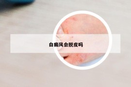 白癜风会脱皮吗