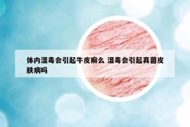 体内湿毒会引起牛皮癣么 湿毒会引起真菌皮肤病吗