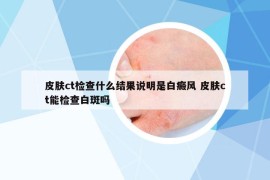 皮肤ct检查什么结果说明是白癜风 皮肤ct能检查白斑吗