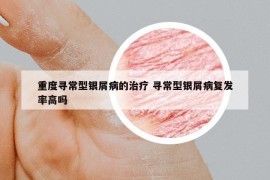 重度寻常型银屑病的治疗 寻常型银屑病复发率高吗