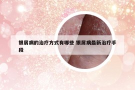 银屑病的治疗方式有哪些 银屑病最新治疗手段