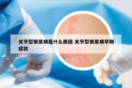 关节型银屑病是什么原因 关节型银屑病早期症状