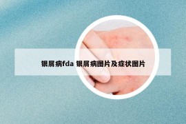 银屑病fda 银屑病图片及症状图片