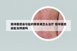 链球菌感染引起的银屑病怎么治疗 链球菌感染能治彻底吗