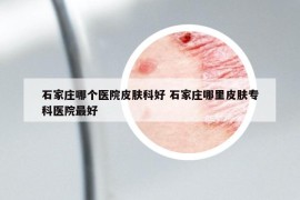 石家庄哪个医院皮肤科好 石家庄哪里皮肤专科医院最好