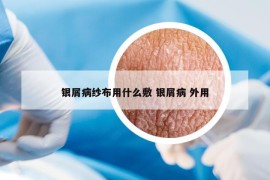 银屑病纱布用什么敷 银屑病 外用