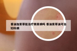 香油加紫草能治疗银屑病吗 香油紫草油可治妇科病