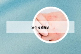 冶牛皮癣秘方