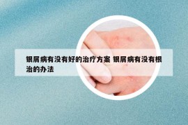 银屑病有没有好的治疗方案 银屑病有没有根治的办法