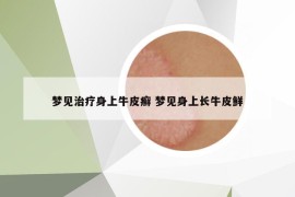 梦见治疗身上牛皮癣 梦见身上长牛皮鲜