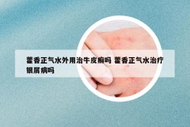 藿香正气水外用治牛皮癣吗 藿香正气水治疗银屑病吗