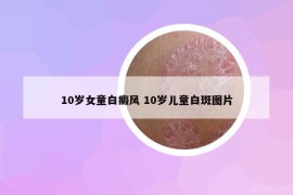 10岁女童白癜风 10岁儿童白斑图片