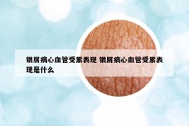 银屑病心血管受累表现 银屑病心血管受累表现是什么