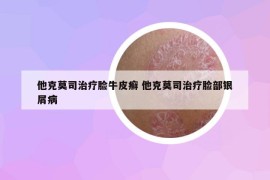 他克莫司治疗脸牛皮癣 他克莫司治疗脸部银屑病