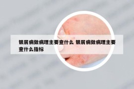 银屑病做病理主要查什么 银屑病做病理主要查什么指标