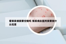 看银屑病需要空腹吗 银屑病去医院需要做什么检查