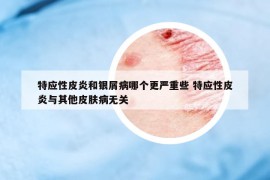 特应性皮炎和银屑病哪个更严重些 特应性皮炎与其他皮肤病无关