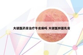 大虢医药膏治疗牛皮癣吗 大虢医抑菌乳膏