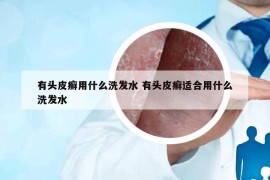 有头皮癣用什么洗发水 有头皮癣适合用什么洗发水