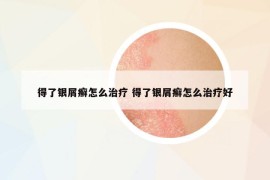 得了银屑癣怎么治疗 得了银屑癣怎么治疗好