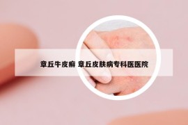 章丘牛皮癣 章丘皮肤病专科医医院