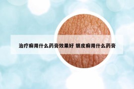 治疗癣用什么药膏效果好 银皮癣用什么药膏