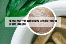 生物制剂治疗银屑病能停吗 生物制剂治疗银屑病可以断根吗