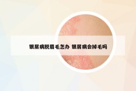 银屑病脱眉毛怎办 银屑病会掉毛吗