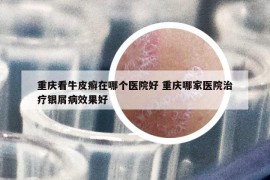 重庆看牛皮癣在哪个医院好 重庆哪家医院治疗银屑病效果好