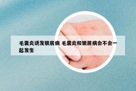 毛囊炎诱发银屑病 毛囊炎和银屑病会不会一起发生