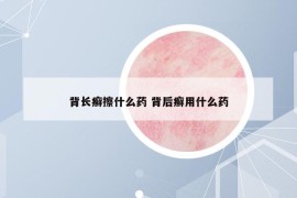 背长癣擦什么药 背后癣用什么药